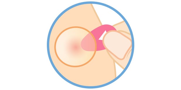 Illustration of fingers holding the tab while applying it to a facial blemish.