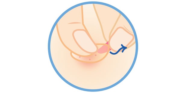 Illustration de doigts retirant la languette et appuyant sur le timbre pour acné pour le mettre en place.